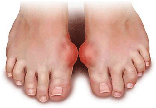 Bệnh Gút-nguyên nhân và cách điều trị