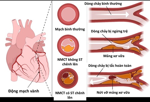 Thói quen xấu khiến người trẻ dễ bị nhồi máu cơ tim