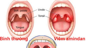 Bài thuốc trị viêm Amidan mạn tính
