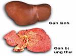 Bệnh ung thư gan có lây không?